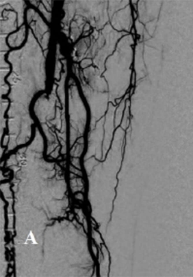 PRE AURYON LASER CTO IN THE SFA