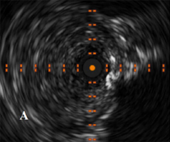 PRE AURYON LASER IVUS SHOWING CTO AND INTRALUMINAL POSITION OF WIRE