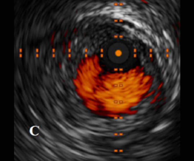 IVUS POST AURYON LASER AND PTA IN THE POPLITEAL ARTERY