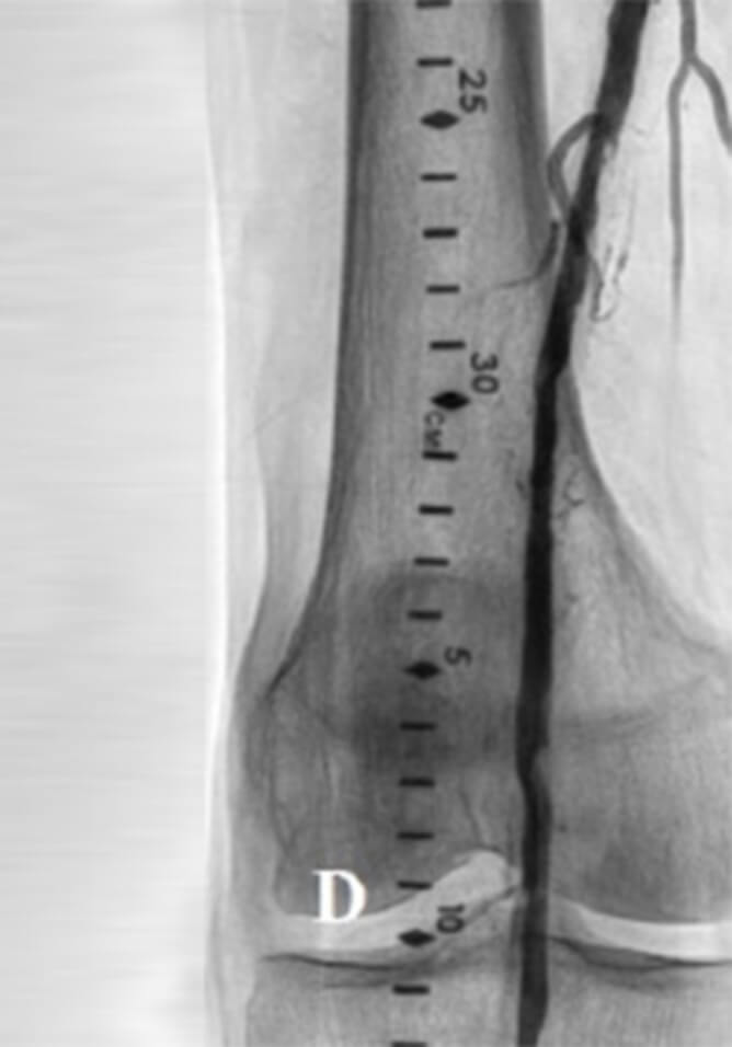 POST AURYON LASER PTA RESULTS POPLITEAL ARTERY